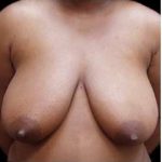 Liposuction and Breast Reduction Before & After Patient #627