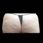 Laser Liposuction and Cellulaze Before & After Patient #765