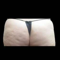 Laser Liposuction and Cellulaze Before & After Patient #765