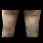 Laser Liposuction and Cellulaze Before & After Patient #768
