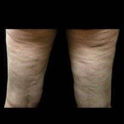 Laser Liposuction and Cellulaze Before & After Patient #768