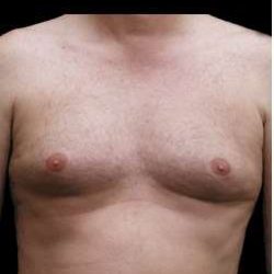 Liposuction and Gynecomastia Before & After Patient #775