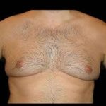Liposuction and Gynecomastia Before & After Patient #786
