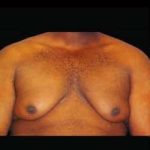 Liposuction and Gynecomastia Before & After Patient #800