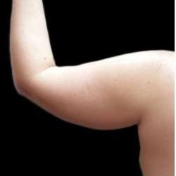 Arm Liposuction Before & After Patient #613