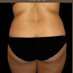 Female Liposuction Before & After Patient #808