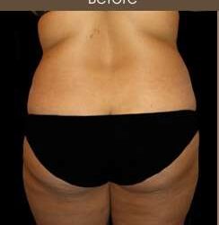 Female Liposuction Before & After Patient #808