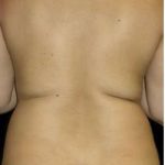 Female Liposuction Before & After Patient #813