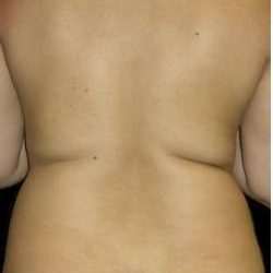 Female Liposuction Before & After Patient #813