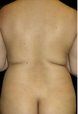 Female Liposuction Before & After Patient #813