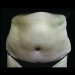 Female Liposuction Before & After Patient #818