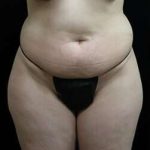 Female Liposuction Before & After Patient #825