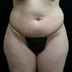 Female Liposuction Before & After Patient #825