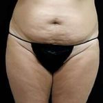 Female Liposuction Before & After Patient #834