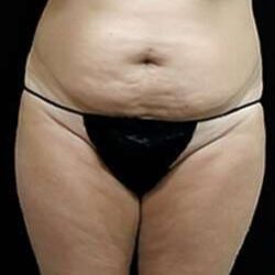 Female Liposuction Before & After Patient #834