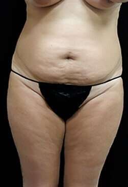 Female Liposuction Before & After Patient #834