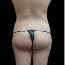 Female Liposuction Before & After Patient #843