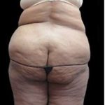 Female Liposuction Before & After Patient #855