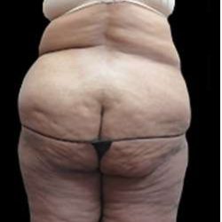 Female Liposuction Before & After Patient #855