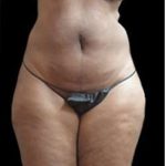 Female Liposuction Before & After Patient #858