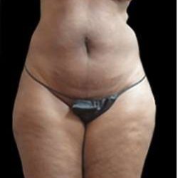 Female Liposuction Before & After Patient #858