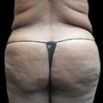 Female Liposuction Before & After Patient #863