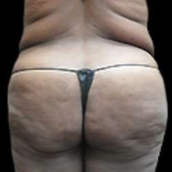 Female Liposuction Before & After Patient #863