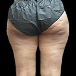 Female Liposuction Before & After Patient #868