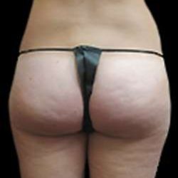 Female Liposuction Before & After Patient #877