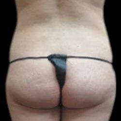 Female Liposuction Before & After Patient #880
