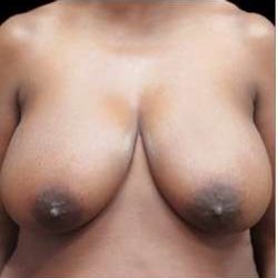 Liposuction and Breast Reduction Before & After Patient #639