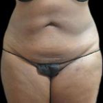 Female Liposuction Before & After Patient #887