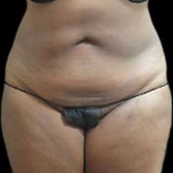 Female Liposuction Before & After Patient #887