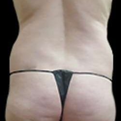 Female Liposuction Before & After Patient #894