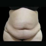 Female Liposuction Before & After Patient #899