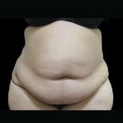 Female Liposuction Before & After Patient #899