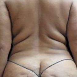 Female Liposuction Before & After Patient #908