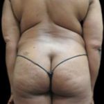 Female Liposuction Before & After Patient #915