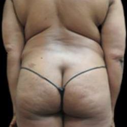 Female Liposuction Before & After Patient #915