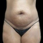 Female Liposuction Before & After Patient #923