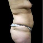 Female Liposuction Before & After Patient #930