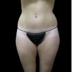 Female Liposuction Before & After Patient #939