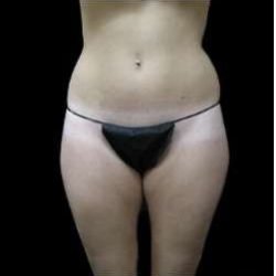 Female Liposuction Before & After Patient #939