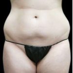 Female Liposuction Before & After Patient #948