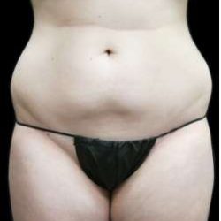 Female Liposuction Before & After Patient #948
