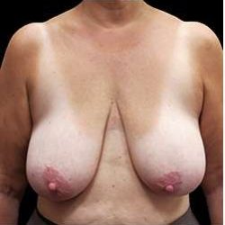 Liposuction and Breast Reduction Before & After Patient #650