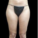 Female Liposuction Before & After Patient #953