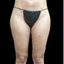 Female Liposuction Before & After Patient #953