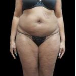 Female Liposuction Before & After Patient #960