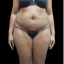 Female Liposuction Before & After Patient #960